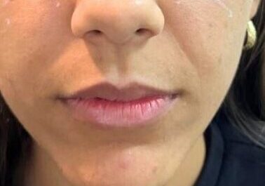 antes preenchimento labial 2 antes preenchimento labial 2