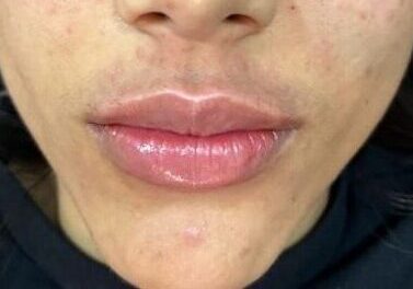 depois preenchimento labial 2