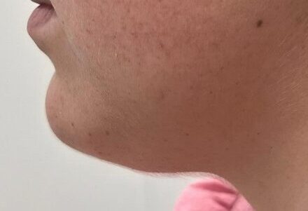 lipo de papada antes lipo de papada antes