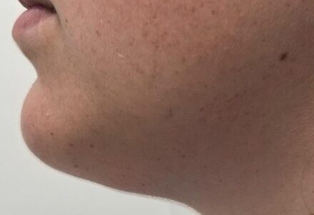lipo de papada depois Sem dor, sem corte. Melhora o contorno facial. Resultado de apenas uma sessão.